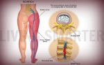 Fibromyalgia and Sciatica Pain
